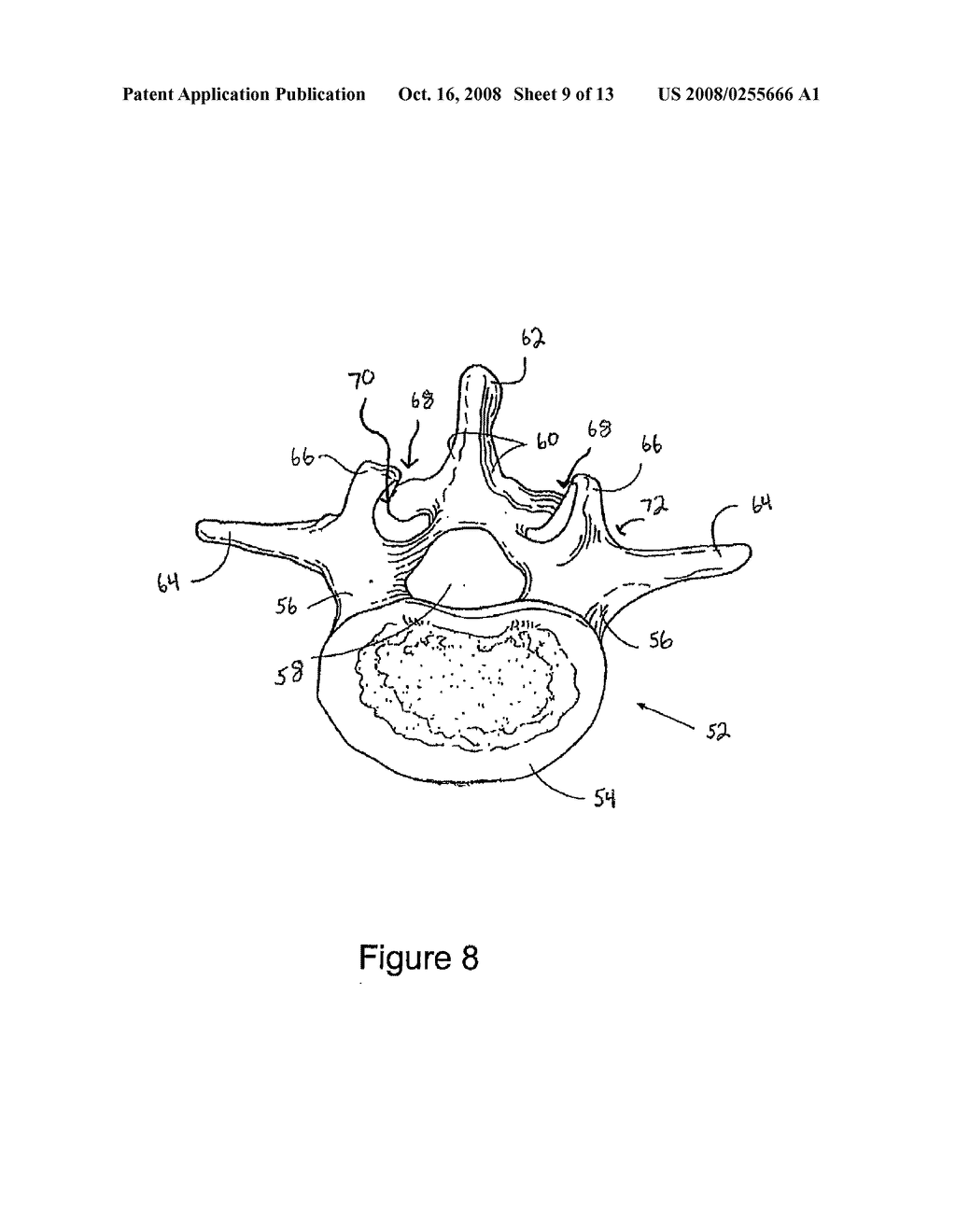 FACET FIXATION AND FUSION WEDGE AND METHOD OF USE - diagram, schematic, and image 10