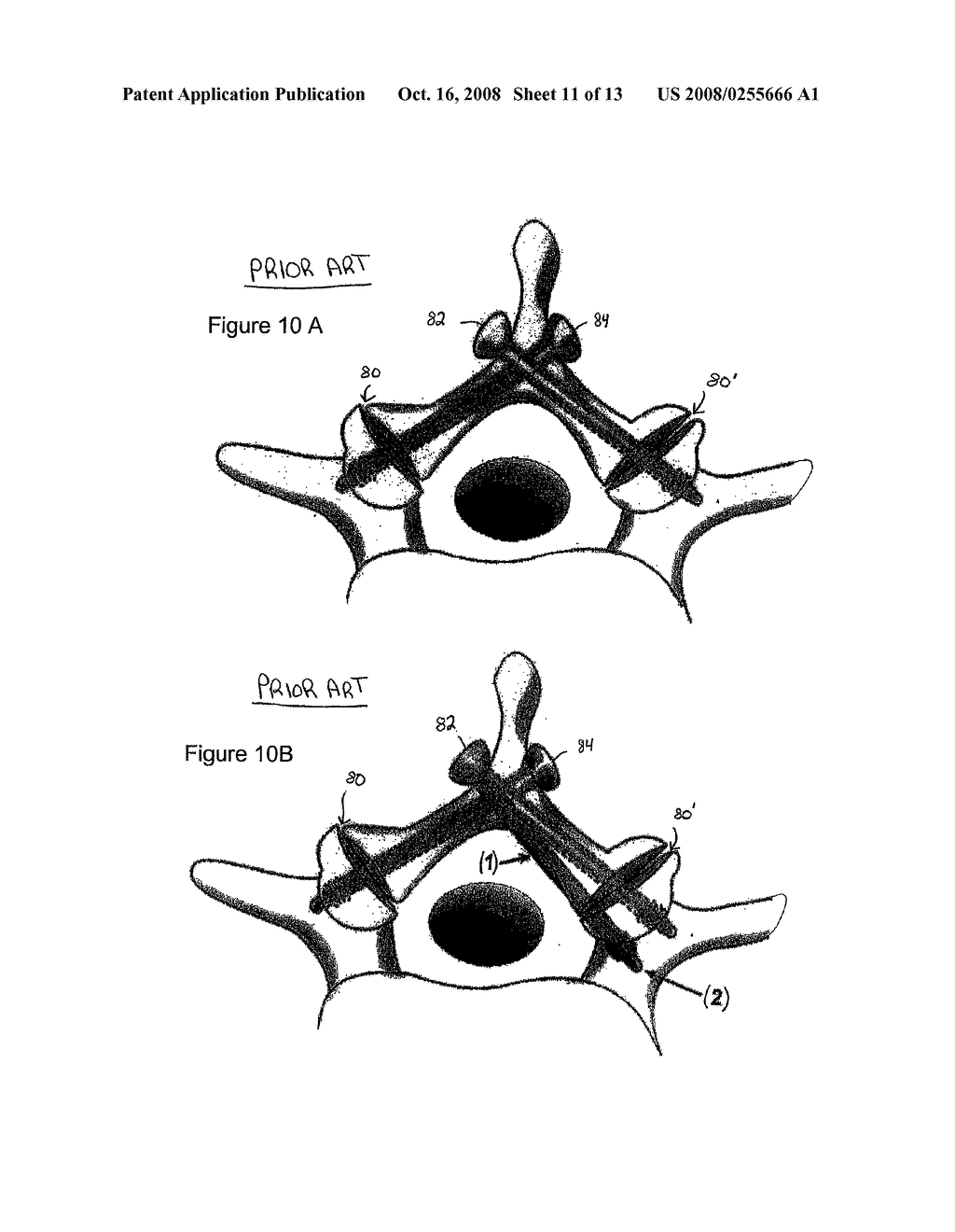 FACET FIXATION AND FUSION WEDGE AND METHOD OF USE - diagram, schematic, and image 12