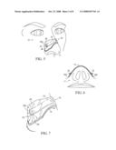 Nasal dilator with means to direct resilient properties diagram and image