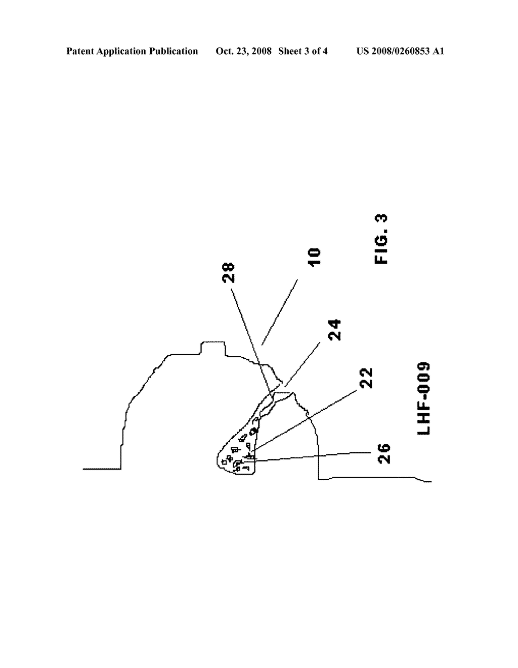 EXTRACELLULAR MATRIX AS SURGICAL ADJUNCT IN A LUMPECTOMY PROCEDURE - diagram, schematic, and image 04