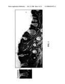 COMPOUNDS, COMPOSITIONS, KITS AND METHODS OF USE TO ORALLY AND TOPICALLY TREAT ACNE AND OTHER SKIN CONDITIONS BY ADMINISTERING A 19-NOR CONTAINING VITAMIN D ANALOG WITH OR WITHOUT A RETINOID diagram and image