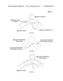 Active blood vessel sleeve methods and systems diagram and image