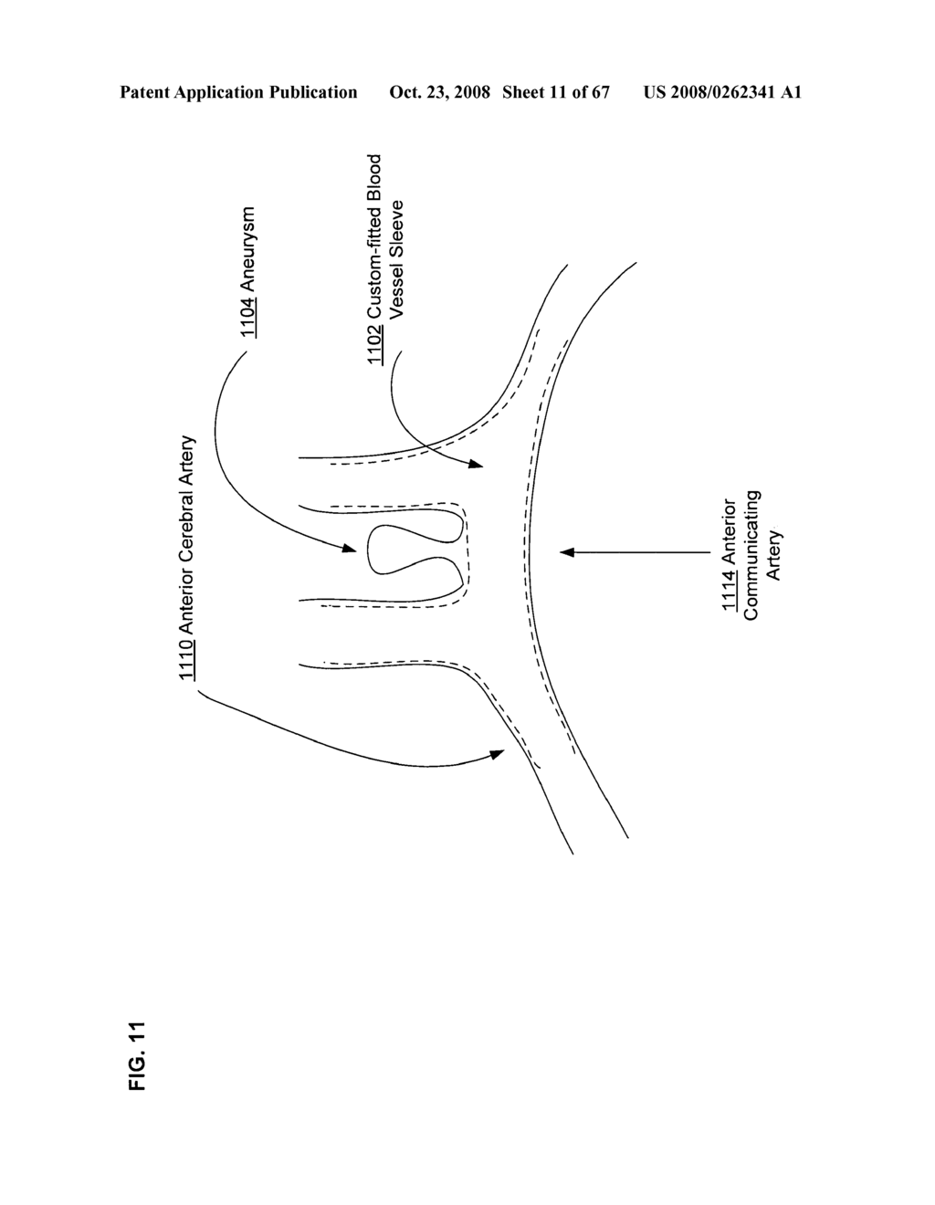 Active blood vessel sleeve methods and systems - diagram, schematic, and image 12