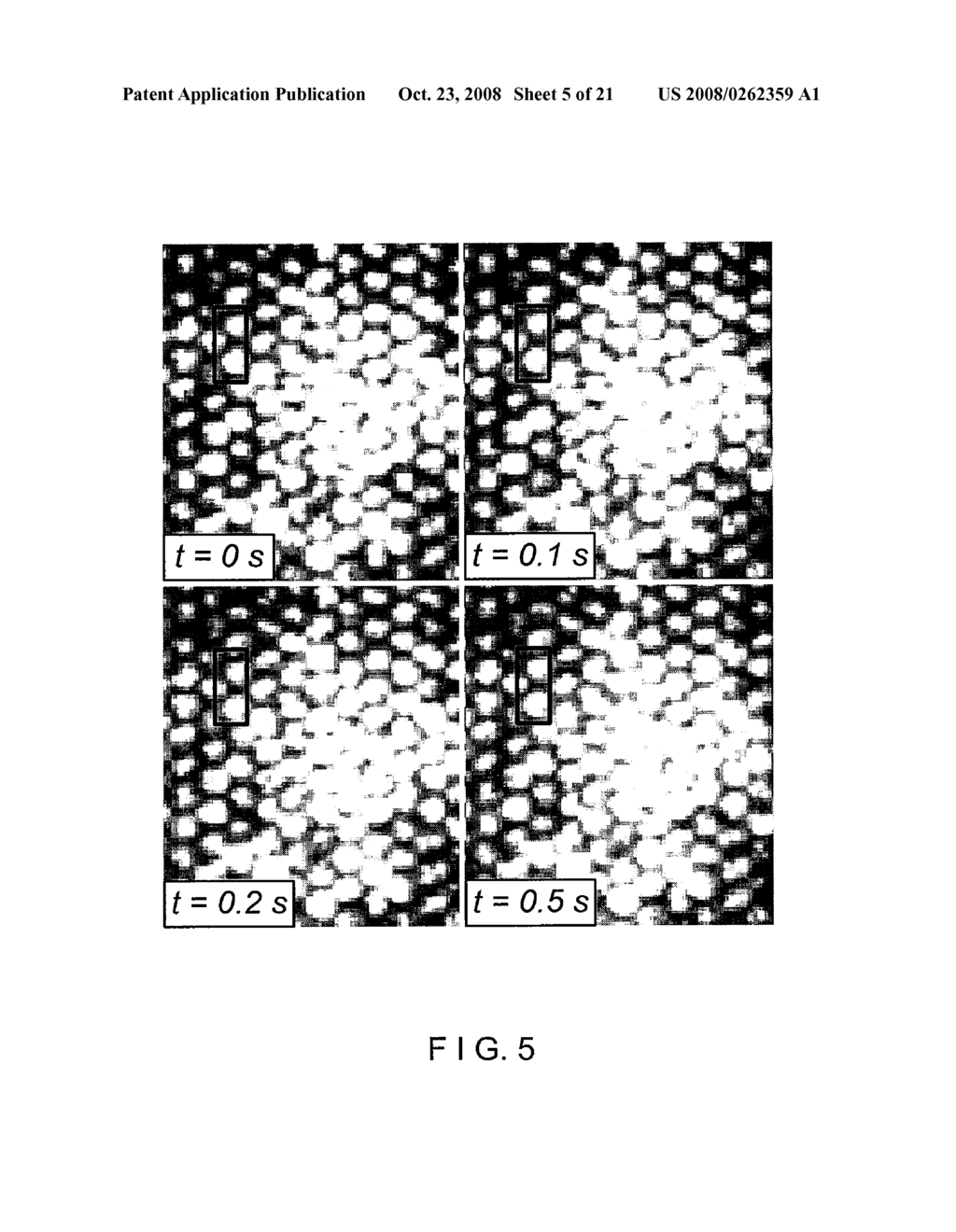 SYSTEM AND METHOD PROVIDING INTRACORONARY LASER SPECKLE IMAGING FOR THE DETECTION OF VULNERABLE PLAQUE - diagram, schematic, and image 06