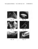 Thrombus removal diagram and image