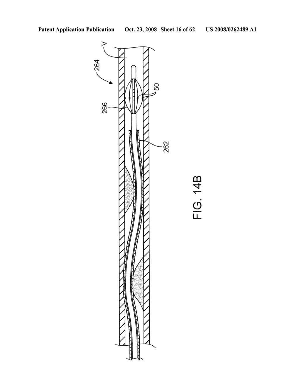 Thrombus removal - diagram, schematic, and image 17