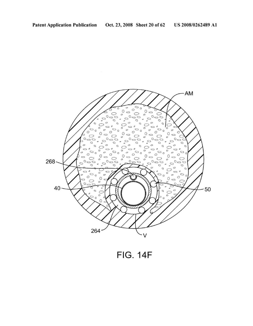 Thrombus removal - diagram, schematic, and image 21