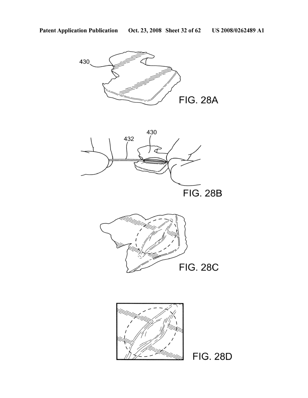 Thrombus removal - diagram, schematic, and image 33