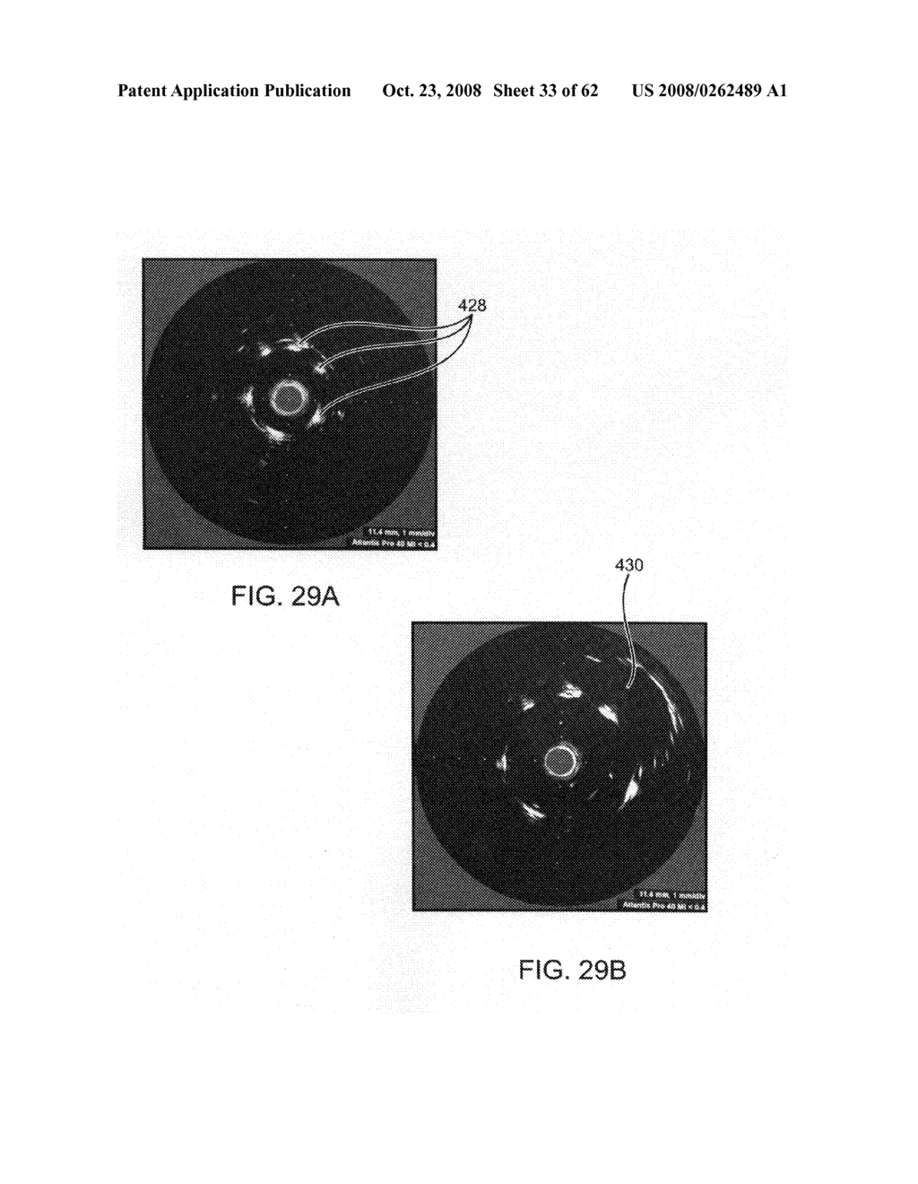 Thrombus removal - diagram, schematic, and image 34