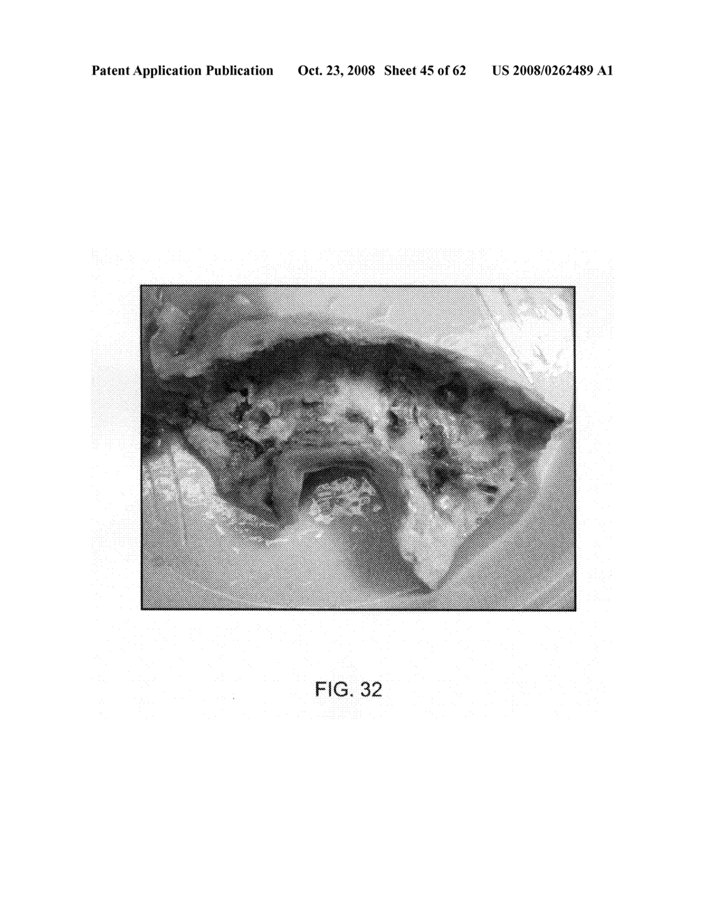 Thrombus removal - diagram, schematic, and image 46