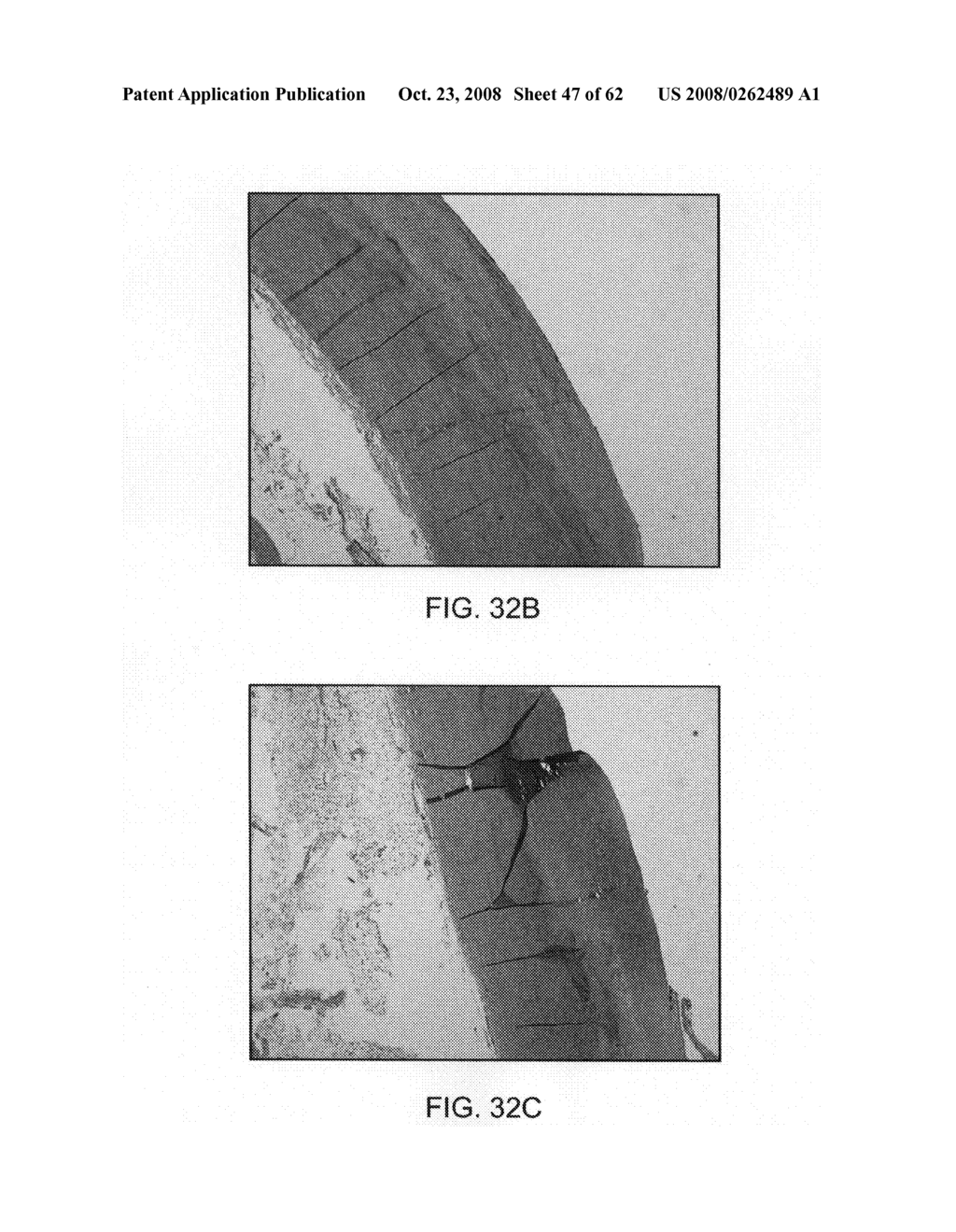 Thrombus removal - diagram, schematic, and image 48