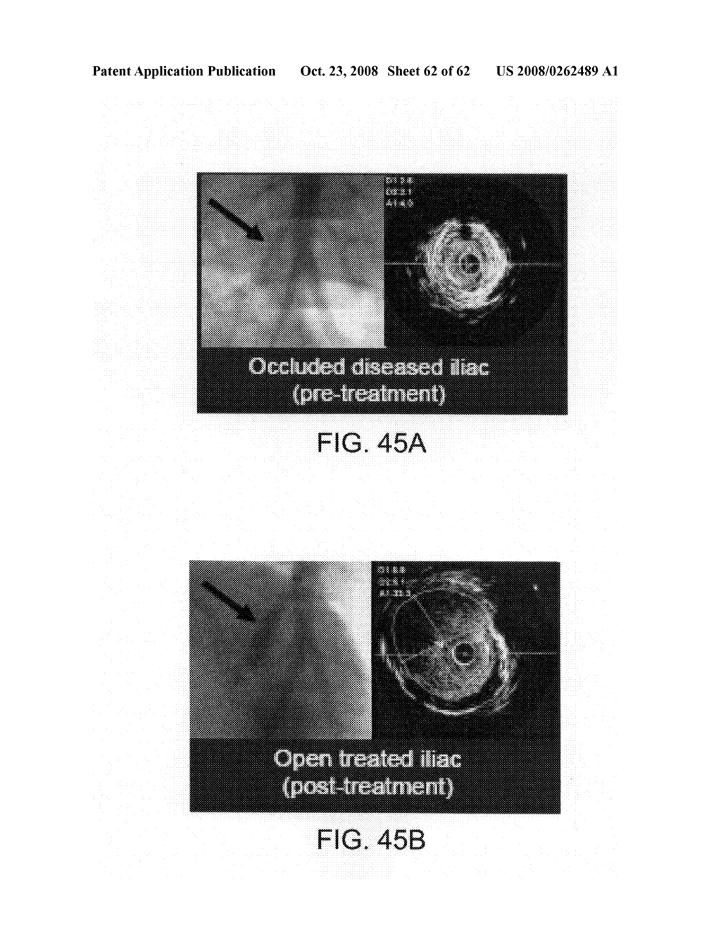 Thrombus removal - diagram, schematic, and image 63