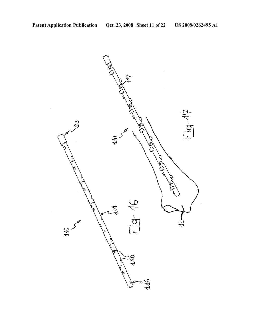 Intramedullary Nail Comprising Elements of Shape-Memory Material - diagram, schematic, and image 12