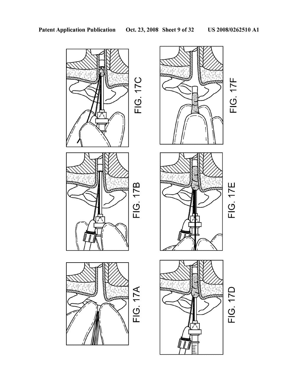 Disposable Iontophoresis System and Tympanic Membrane Pain Inhibition Method - diagram, schematic, and image 10