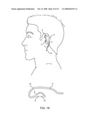 Disposable Iontophoresis System and Tympanic Membrane Pain Inhibition Method diagram and image