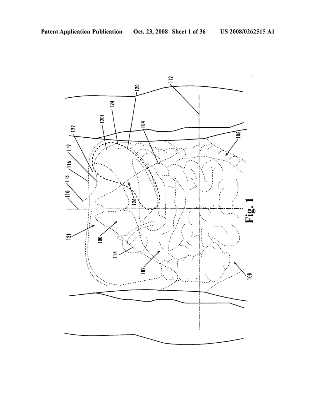 Devices and methods for treatment of obesity - diagram, schematic, and image 02