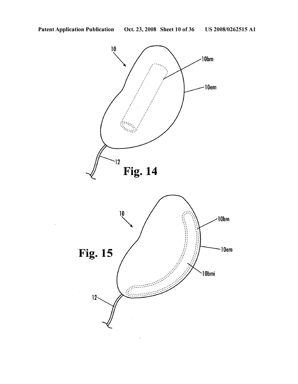 Devices and methods for treatment of obesity - diagram, schematic, and image 11