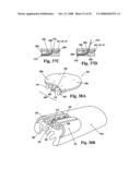 Devices and methods for treatment of obesity diagram and image