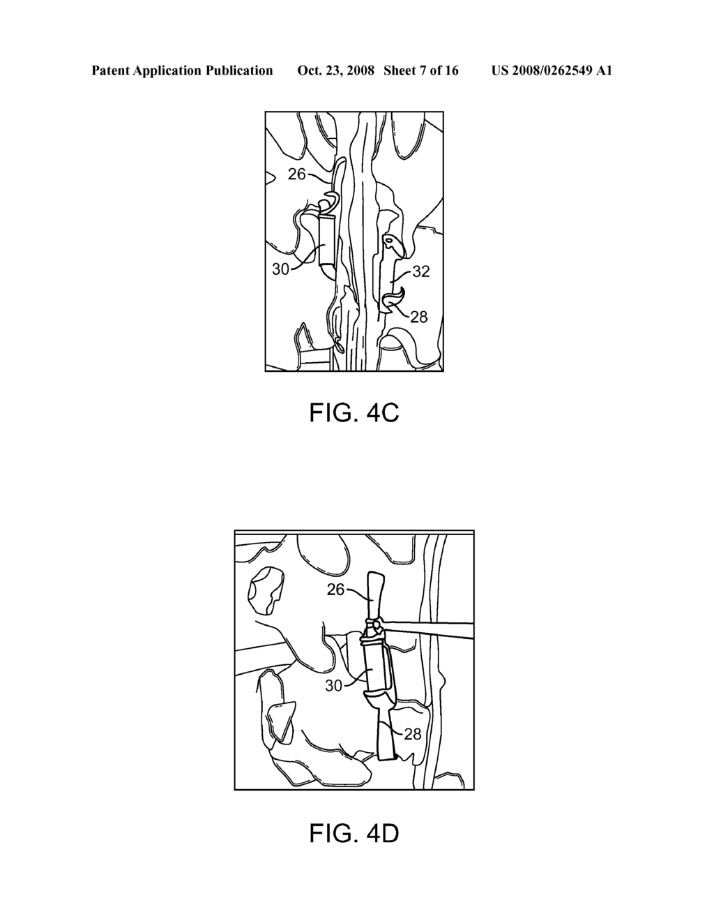 METHODS AND SYSTEMS FOR DEPLOYING SPINOUS PROCESS CONSTRAINTS - diagram, schematic, and image 08