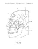 METHODS AND SYSTEMS OF TREATING MEDICATION OVERUSE HEADACHE diagram and image