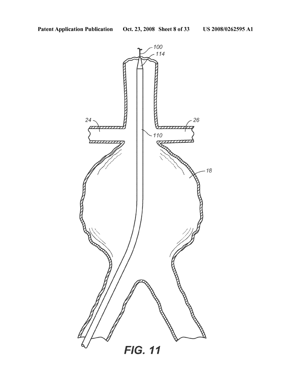 Methods and Apparatus for Treatment of Aneurysms Adjacent to Branch Arteries - diagram, schematic, and image 09