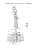 INTERSPINOUS SPACER diagram and image