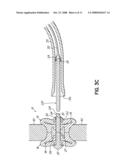 INTERSPINOUS SPACER diagram and image