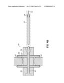 INTERSPINOUS SPACER diagram and image