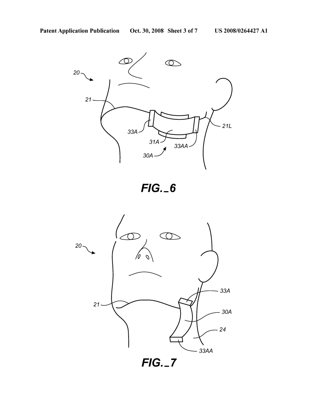 METHOD AND APPARATUS FOR TREATMENT OF SNORING AND SLEEP APNEA - diagram, schematic, and image 04