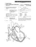 STEERABLE LESION EXCLUDING HEART IMPLANTS FOR CONGESTIVE HEART FAILURE diagram and image