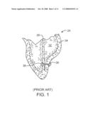 STEERABLE LESION EXCLUDING HEART IMPLANTS FOR CONGESTIVE HEART FAILURE diagram and image