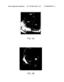 STEERABLE LESION EXCLUDING HEART IMPLANTS FOR CONGESTIVE HEART FAILURE diagram and image