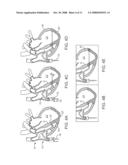 STEERABLE LESION EXCLUDING HEART IMPLANTS FOR CONGESTIVE HEART FAILURE diagram and image