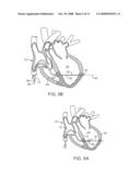 STEERABLE LESION EXCLUDING HEART IMPLANTS FOR CONGESTIVE HEART FAILURE diagram and image