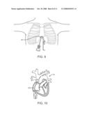 STEERABLE LESION EXCLUDING HEART IMPLANTS FOR CONGESTIVE HEART FAILURE diagram and image