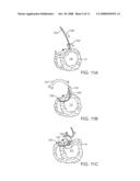 STEERABLE LESION EXCLUDING HEART IMPLANTS FOR CONGESTIVE HEART FAILURE diagram and image