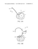 STEERABLE LESION EXCLUDING HEART IMPLANTS FOR CONGESTIVE HEART FAILURE diagram and image