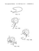 STEERABLE LESION EXCLUDING HEART IMPLANTS FOR CONGESTIVE HEART FAILURE diagram and image