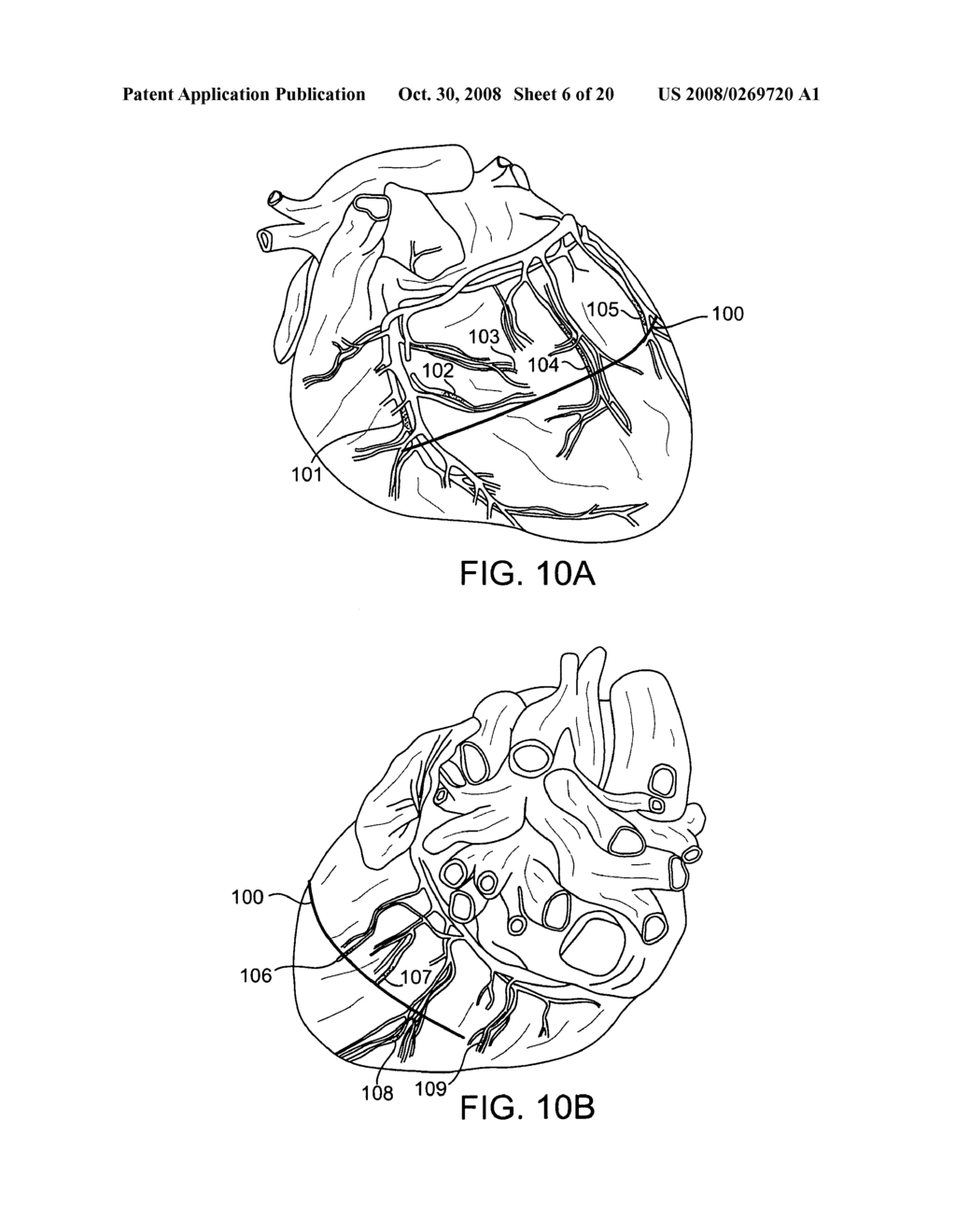 Cardiac repair, resizing and reshaping using the venous system of the heart - diagram, schematic, and image 07