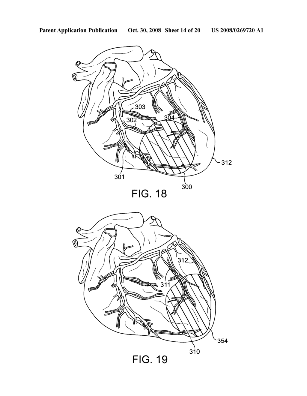 Cardiac repair, resizing and reshaping using the venous system of the heart - diagram, schematic, and image 15