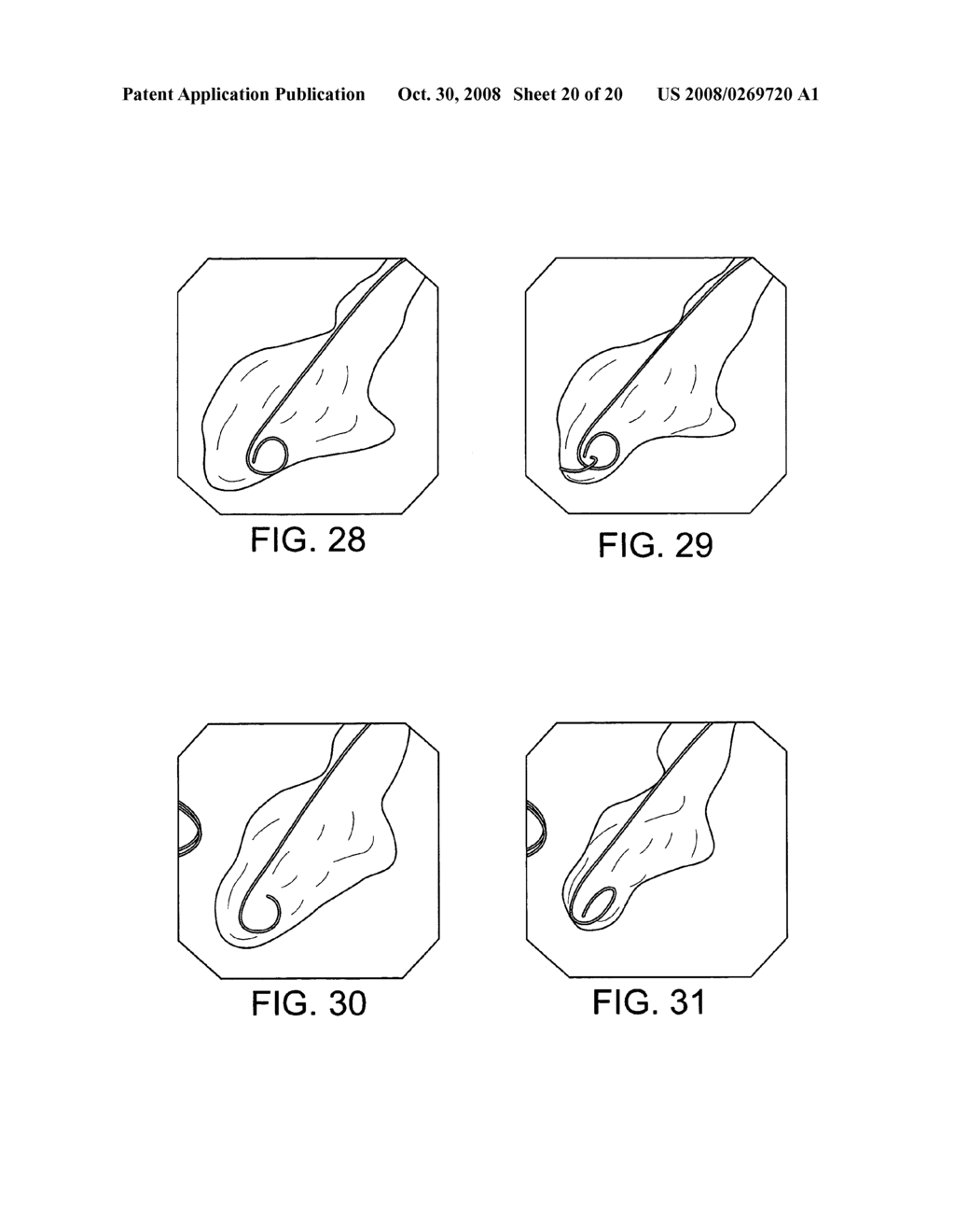 Cardiac repair, resizing and reshaping using the venous system of the heart - diagram, schematic, and image 21