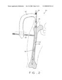 NAIL CAP CANNULA diagram and image