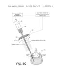 BONE TREATMENT SYSTEMS AND METHODS diagram and image