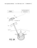 BONE TREATMENT SYSTEMS AND METHODS diagram and image