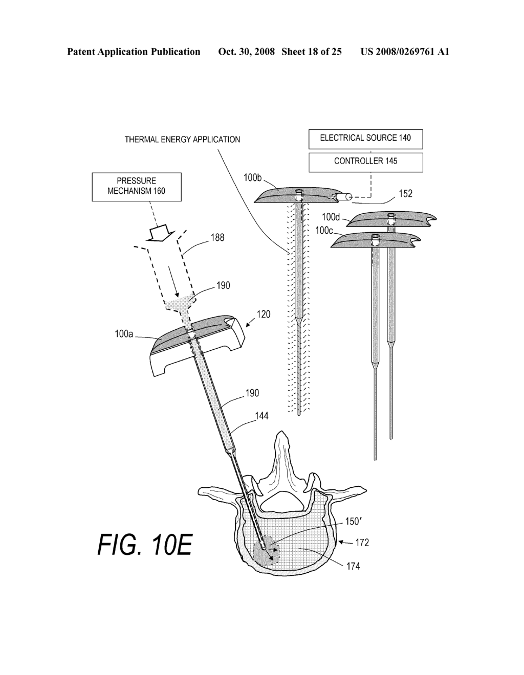 BONE TREATMENT SYSTEMS AND METHODS - diagram, schematic, and image 19