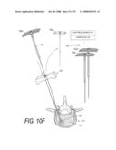 BONE TREATMENT SYSTEMS AND METHODS diagram and image