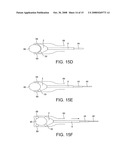 Obstetric Vacuum Extractor diagram and image