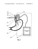 Trans-esophageal vagus nerve stimulation diagram and image