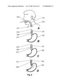 Trans-esophageal vagus nerve stimulation diagram and image