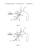 Implantable medical device for treating neurological conditions with an initially disabled cardiac therapy port and leadless ECG sensing diagram and image